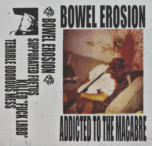 Bowel Erosion : Addicted to the Macabre